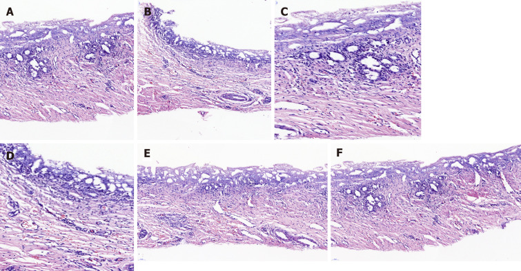 Hematoxylin/eosin staining of the animal-derived artificial bile duct site. No marked transmural neutrophil and lymphoplasma cell infiltration was observed. A: Hematoxylin/eosin (H/E) staining of a 6 mo survival pig in group A (magnification: 20 ×); B: H/E staining of a 12 mo survival pig in group B (magnification: 20 ×); C: H/E staining of a 6 mo survival pig in group A (magnification: 40 ×); D: H/E staining of a 12 mo survival pig in group B (magnification: 40 ×); E and F: H/E staining result of neovascularization was marked in group A and B (magnification: 20 ×).
