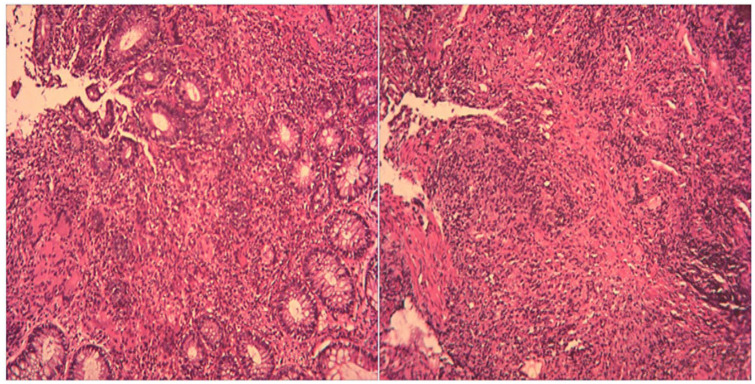 Inflammatory cells infiltration in intestinal wall and there were multiple granulomatous lesions without obvious caseous necrosis.