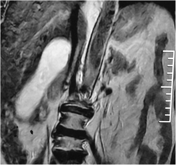 MRI showing mucocele of gall bladder (coronal plane)