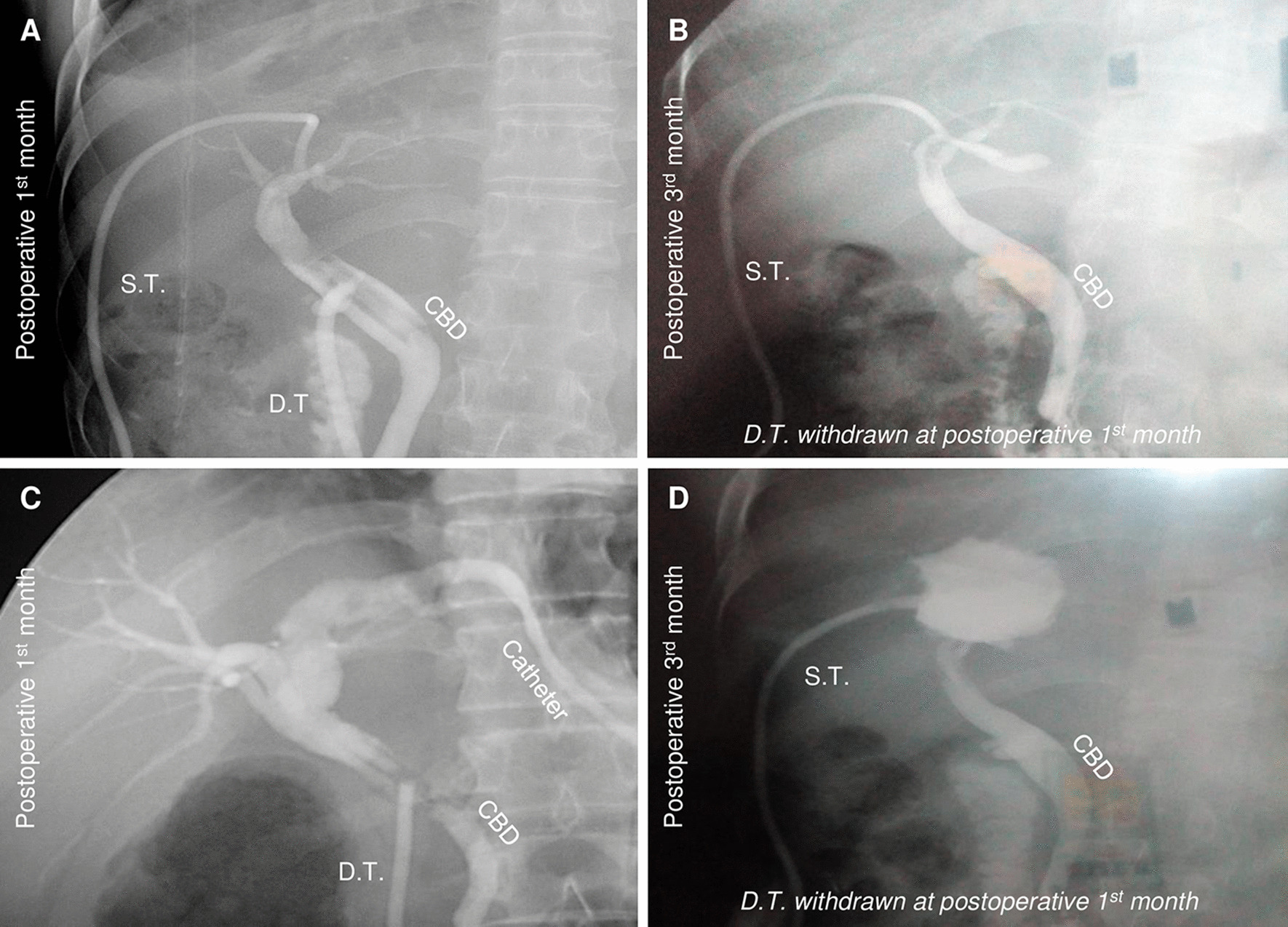 Postoperative cholangiograms for the tubes/catheters. a Satisfactory drainage without obvious leakage at postoperative first month (corresponding to double T-tube drainage); b Satisfactory healing of the cavity without apparent leakage at postoperative third month after withdrawal of decompression T-tube at postoperative one month (corresponding to double T-tube drainage for the same patient in a in this figure); c Qualified drainage without obvious leakage at postoperative first month (corresponding to single T-tube drainage with sutured fistula); d unsatisfactory outcome of the original leakage in cystic cavity at postoperative third month, note that this leakage had not been observed at postoperative first month, which indicated late leakage at original cysto-biliary communication site after withdrawal of decompression T-tube at first month (corresponding to single T-tube drainage with sutured fistula)