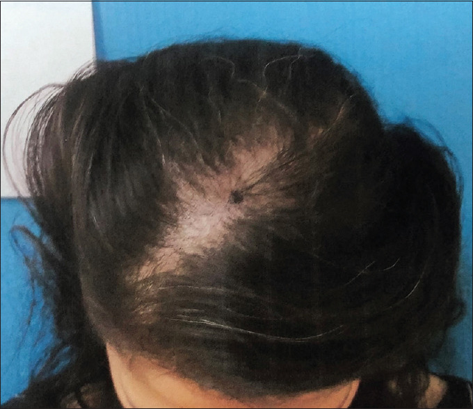 Female– Day 0–16 hairs/cm2
