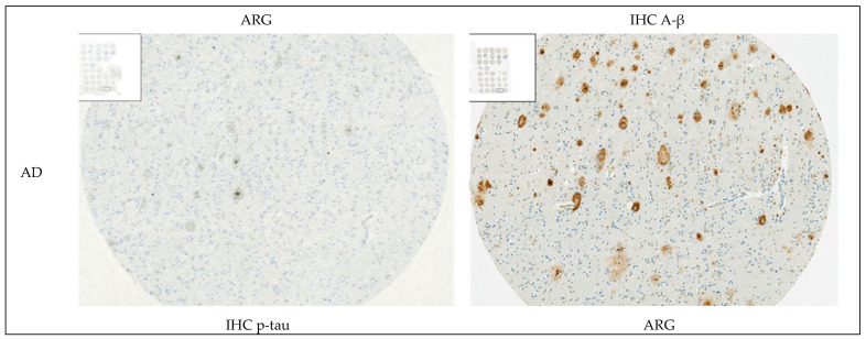 Representative high magnification images from immunohistochemistry (IHC) and emulsion autoradiography (ARG) with 25 nM [3H]GMC-058 performed on TMA sections from one case with Alzheimer’s disease (AD) and one case with progressive supranuclear palsy (PSP). The ARG signal corresponds to dense A-β plaques in AD and p-tau inclusions in PSP.