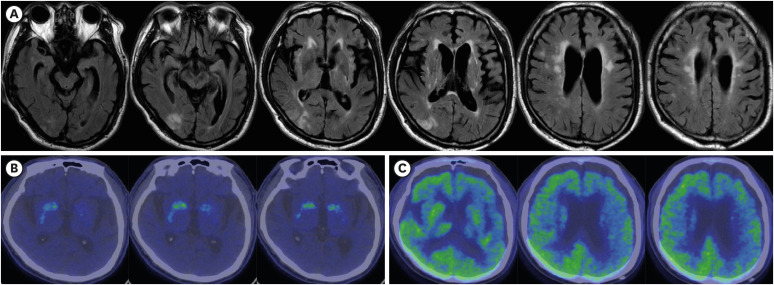Brain MRI and PET images of the patient. (A) T2 FLAIR-weighted axial brain MRI revealed acute right parietotemporal infarction, significant atrophy in the midbrain, and diffuse frontotemporal lobes, more severe on the left. (B) FP-CIT PET revealed decreased uptake in the tail portion of the bilateral putamens and caudate nuclei. (C) FDG-PET detected diffuse and asymmetrically decreased uptake in the left frontotemporal cortex, parietal lobe, and thalamus.FDG = fluorodeoxyglucose, FP-CIT = fluoro-propyl-carbomethoxy-iodophenyl-tropane, MRI = magnetic resonance imaging, PET = positron emission tomography.