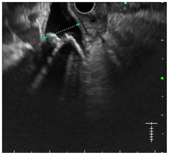 EUS shows multiple stones in a dilated common bile duct.