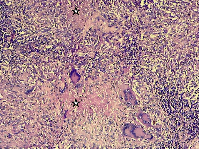 Gx100 coloration HE – follicules épithélio-gigantocellulaires avec couronne lymphocytaire centrant une nécrose éosinophile centrale incomplète (étoile)Gx100 HE stain – epithelio-giganto-cellular follicles with lymphocytic corona centering incomplete central eosinophilic necrosis (star)