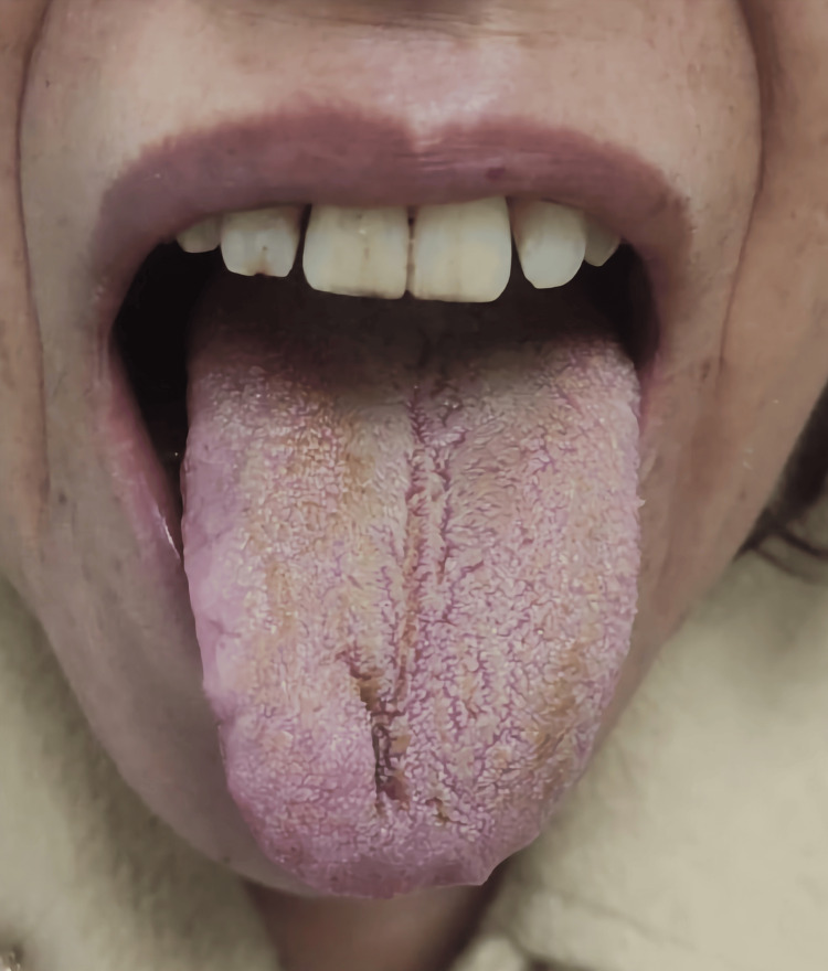 Black hairy tongue two months after discharge from the hospital.Consent to publish the image was obtained from the patient.