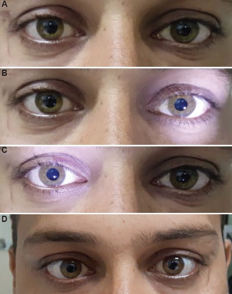 Dilated pupils in both eyes (A) and sluggishly reacting on direct and consensual reflexes (B and C) as well as near reflex (D) in a 25 yr old male patient with a history of smoking marijuana. Patient presented with a one week history. Pilocarpine one per cent drops were described to relieve symptoms.