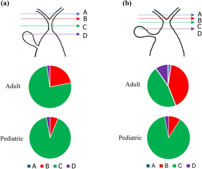 Results of the nationwide expert survey of adult and pediatric institutions on the hepatic hilum‐side transection line in Todani's Type I CBD. (a) Without dilatation at the confluence of right and left hepatic duct. (b) With dilatation at the confluence of right and left hepatic ducts. The transection lines were categorized as A–D: A (blue line), above the confluence of the hepatic ducts; B (red line), at the confluence of the hepatic ducts (two holes); C (green line), at the confluence of hepatic ducts (single hole); and D (purple line), below the confluence, on the duodenal side (dilated portion).