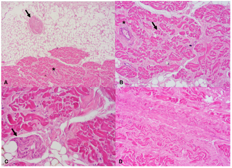 Sino-atrial node: (A) sections of a nerve fiber (arrow) near the sino-atrial node and of a branch of the artery of the sino-atrial node (asterisk) (Hematoxylin and eosin stain, 40× magnification); (B) section of a branch of the artery of the sino-atrial node (asterisk). A group of pacemaker cells is indicated by an arrow (Hematoxylin and eosin stain, 100× magnification); (C) section of a nerve fiber (arrow) running into the sino-atrial node (Hematoxylin and eosin stain, 200× magnification); (D) fibrosis of the sino-atrial node can be clearly seen (Hematoxylin and eosin stain, 100× magnification).