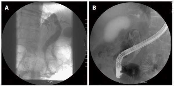 Stone formation 29 mo after stent insertion. A: Plastic biliary stent inserted for common bile duct stricture without stone; B: Large brown stone filled the bile duct.