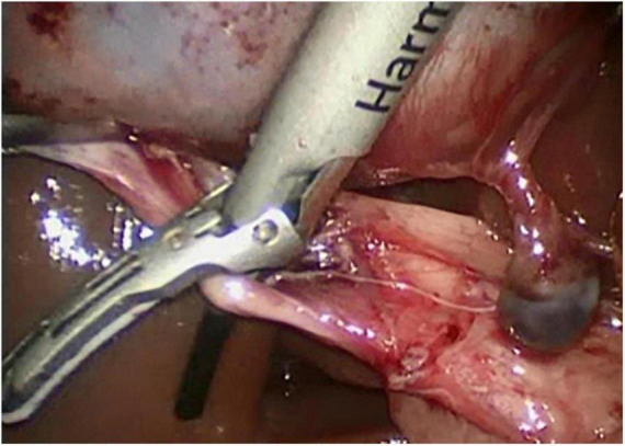 Delivery of the harmonic shear around the cystic duct.