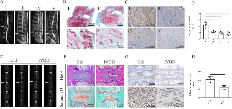 Low expression of CB2 was observed in both human and rat degenerative NP tissue. A Preoperative MRI of participants, who were divided into 4 groups (level: I, III, IV, V) according to the Pfirrmann classification. B Safranin O staining of participant NP tissues; scale bar, 1000 μm. C Representative specimens of immunohistochemical CB2 staining in the 4 separate groups (level: I, III, IV, and V) of participant NP tissues; scale bar, 100 μm. D Quantitative analysis of IHC staining of CB2 (*p < 0.05). E Representative MRI showing the signal intensity of IVD in rats. F H&E and safranin O staining, scale bar, 1000 μm. G Representative specimens of paraffin sections with IHC of CB2 in normal and IVDD rats. H Quantitative analysis of CB2 IHC staining (*p < 0.05). (n = 5 Independent experiments)