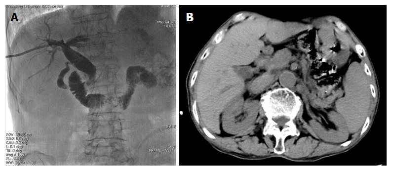Computed tomography and postoperative cholangiography demonstrating that there was no residual of common bile duct stones or gallstones. A: Intraoperative cholangiography confirmed the absence of all stones and external drainage tube was left; B: Furthermore, 3-5 d after the procedure, cholangiography was performed again with no residual of stones, and the catheter was retrieved.