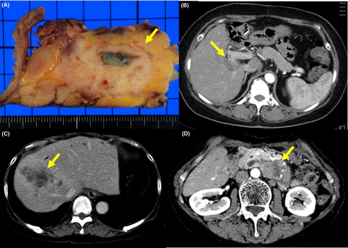 Cholangiocarcinoma and pancreatic cancer detected after the biliary diversion operation. A, Cholangiocarcinoma (arrow) is present around the residual bile duct in the pancreas. B, Space‐occupying lesion (hilar cholangiocarcinoma) is present (arrow). C, Space‐occupying lesion (intrahepatic cholangiocarcinoma) is present (arrow). D, Space‐occupying lesion (pancreatic cancer) is present (arrow)