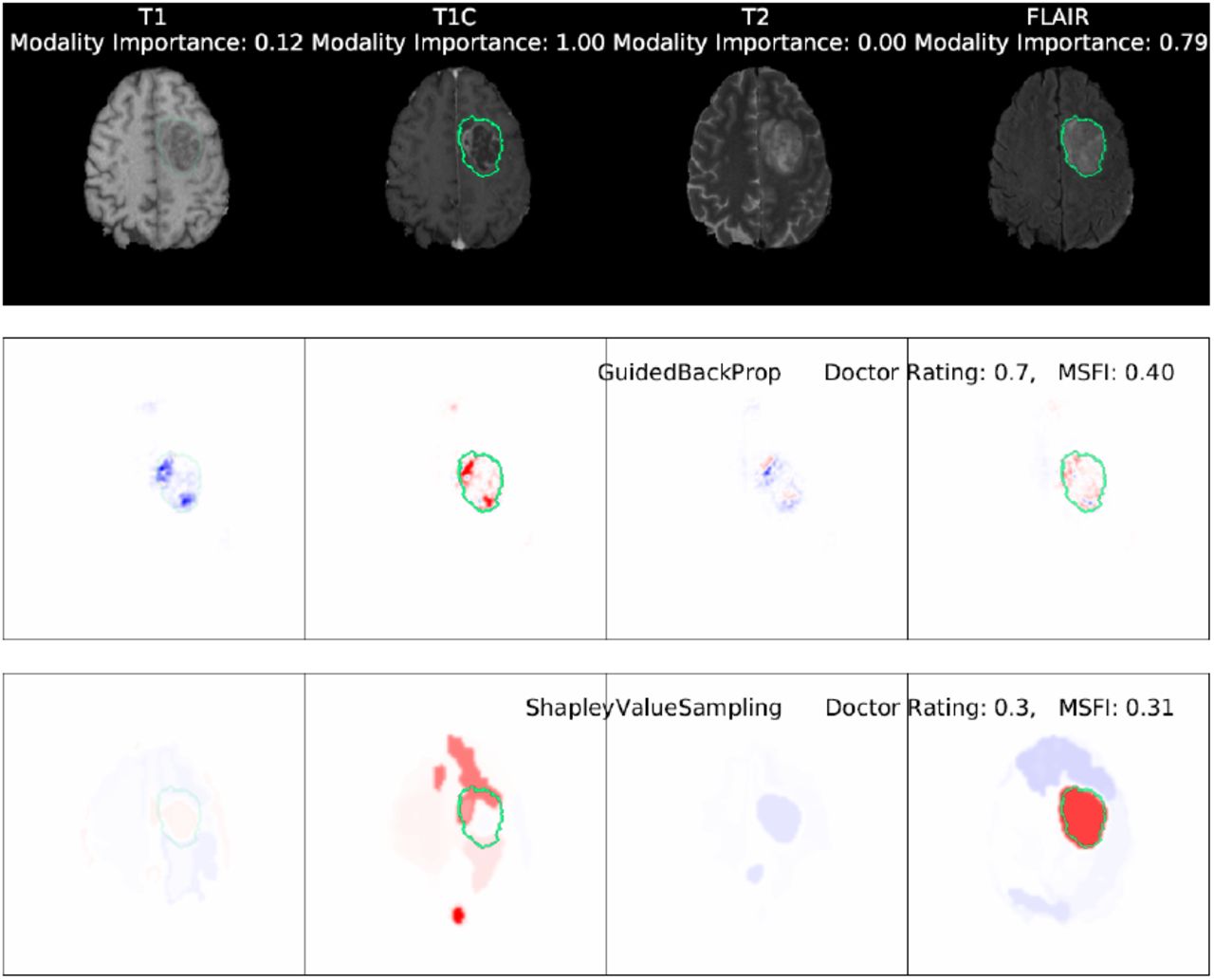 MRI images of a high-grade glioma, alongside saliency maps generated by two methods: Guided Backpropagation and Shapley Value Sampling [266]. This Figure is licensed under CC-BY-NC-ND.