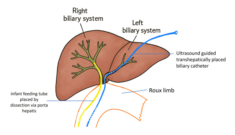 Schematic representation of the procedure done, with the placement of the stents.Original illustration created by the authors using Microsoft PowerPoint (Microsoft Corp., Redmond, WA, USA)