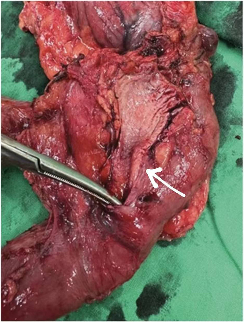 Tissue resected from Whipple operation. Posterior view of common bile duct (CBD). Distal CBD wall thickness (arrow). The tip of instrument is passed from distal CBD and ampullar vater into 2nd portion of duodenum.