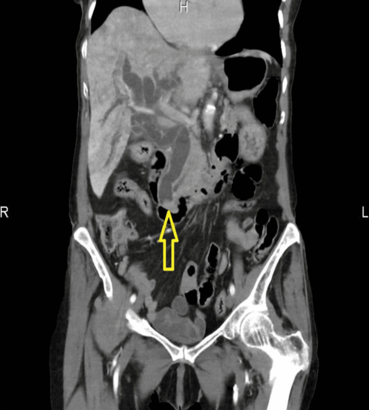 Coronal section of pre-ERCP CT showing dilated CBD and stone at the distal CBD (yellow open arrow). ERCP: endoscopic retrograde cholangiopancreatography; CT: computed tomography; CBD: common bile duct