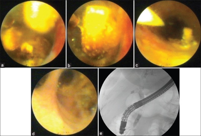 (a) Spyglass view of multiple large common bile duct stones. (b) Spyglass-guided electrohydraulic lithotripsy (EHL) with the tip of the catheter targeting a large common bile duct (CBD) stone. (c) Spyglass view post-EHL therapy of a CBD stone.(d) Spyglass view of the right and the left intrahepatic duct in a patient with multiple difficult intrahepatic and extrahepatic duct stones. (e) Cholangiogram showing numerous large CBD and common hepatic duct stones for which three ERCP attempts with conventional methods failed to clear the CBD