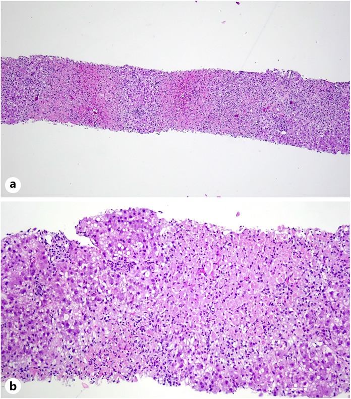 Transjugular liver biopsy (hematoxylin and eosin). a Diffuse centrilobular confluent necrosis affecting acinar zones 3 and 2 with mild inflammation, mainly lymphocytes and histiocytes and normal portal tracts (×4). b Viable hepatocytes with diffuse reactive changes and cytoplasmatic swelling and mild macrovesicular steatosis (×10).