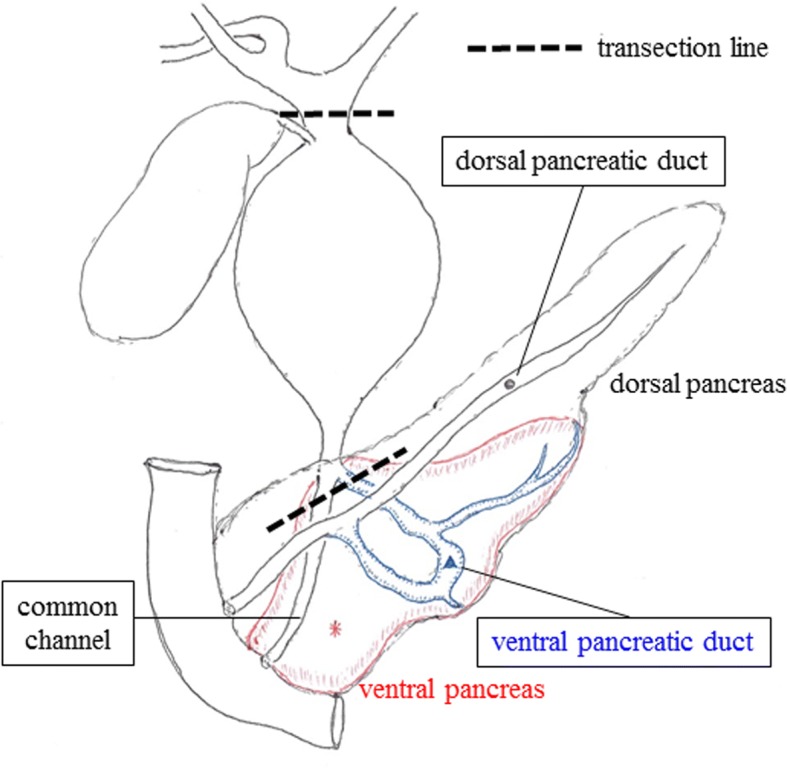 Anatomical schema of the pancreaticobiliary system in this patient. This patient was diagnosed with the “complex type” classification of pancreaticobiliary maljunction with incomplete pancreas divisum. Extrahepatic bile duct resection and hepaticojejunostomy were performed based on the transection line of this schema