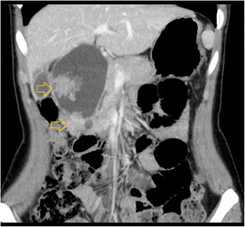 Abdominal CT showed two enhanced tumors (diameter, 4 cm) in the inferior and middle bile duct. Yellow arrows indicate the tumor locations