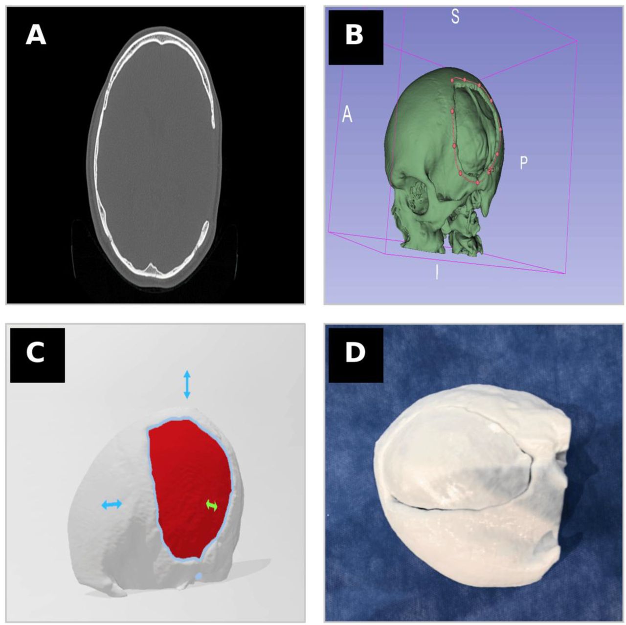 Workflow for customized cranioplasty using 3D-printed molds(A) Axial CT scan demonstrating the cranial defect.(B) Three-dimensional reconstruction with segmentation and definition of defect margins.(C) Digital modeling of the patient-specific implant and mold.(D) Final 3D-printed mold prior to intraoperative use.