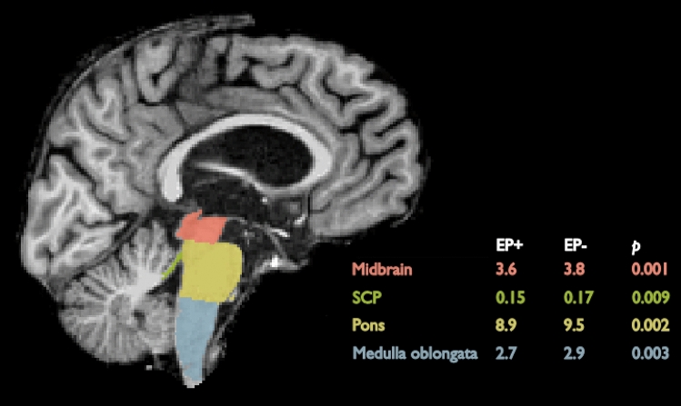 An illustration of brainstem structures and mean volumes (cm3) in the EP + and EP− groups. The structures are labeled on the brain of 58-year-old bvFTD patient with EP symptoms