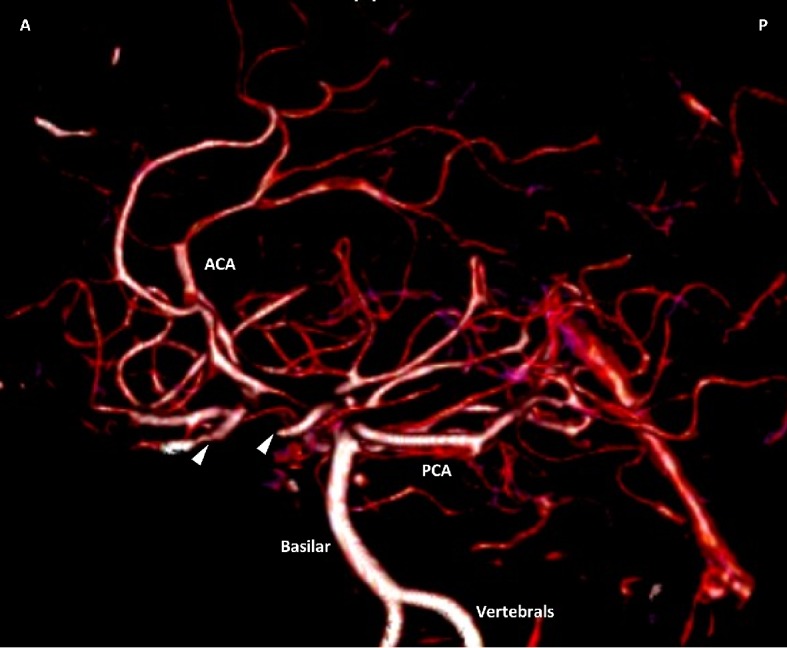 CT angiography of the head and neck with 125 mL Optiray 350 contrast enhanced 3D volume rendered image, with white arrowheads showing ICA occlusions.