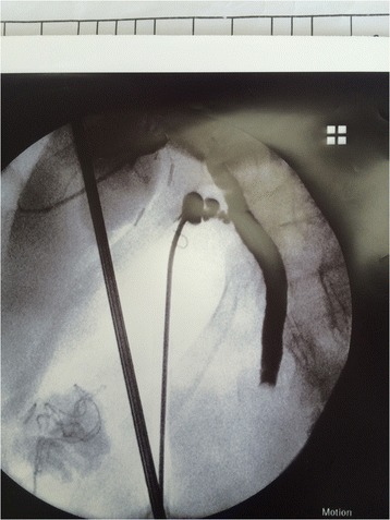 intraoperative cholangiogram showing a filling defect that prevents passage of contrast into the duodenum