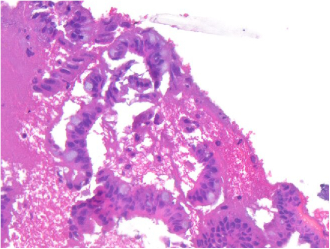 Pathology of superficial fragments of bile duct mucosa showing lymphoplasmacytic inflammation, no evidence of high grade dysplasia or carcinoma.