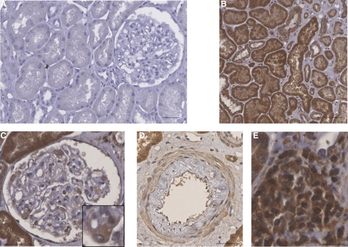 Cannabinoid receptor 1 expression in 3 mo biopsies of renal grafts developing CAD revealed by peroxidase immunohistochemistry. A, Absence of CAD: CB1 was not expressed. The biopsy was performed in a 66‐y‐old man who received a kidney graft from extended criteria donor. Early allograft history was unremarkable. M3 graft biopsy exhibited a normal graft according to the Banff classification, without lesions nor IF/TA. M3 creatininemia was 128 µmol/L and immunosuppressive regimen included prednisone, mycophenolate mofetil and tacrolimus (T0 4.5 ng/mL). B, CB1 expression in tubular epithelial cells. C, CB1 glomerular expression is mainly found in the podocyte (in the inset). D, CB1 expression in medium‐sized arteries: endothelial cells, smooth muscle cells of media and to a lesser extent intimal cells express CB1. E, CB1 expression in the interstitial inflammatory infiltrate. Bar scales = 50 µm. Abbreviations: CAD, chronic allograft dysfunction; IF/TA, interstitial fibrosis and tubular atrophy