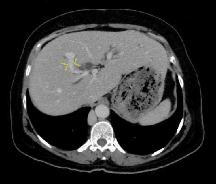 Communication (yellow arrows) between the two portal veins inside the liver parenchyma near segment VIII.