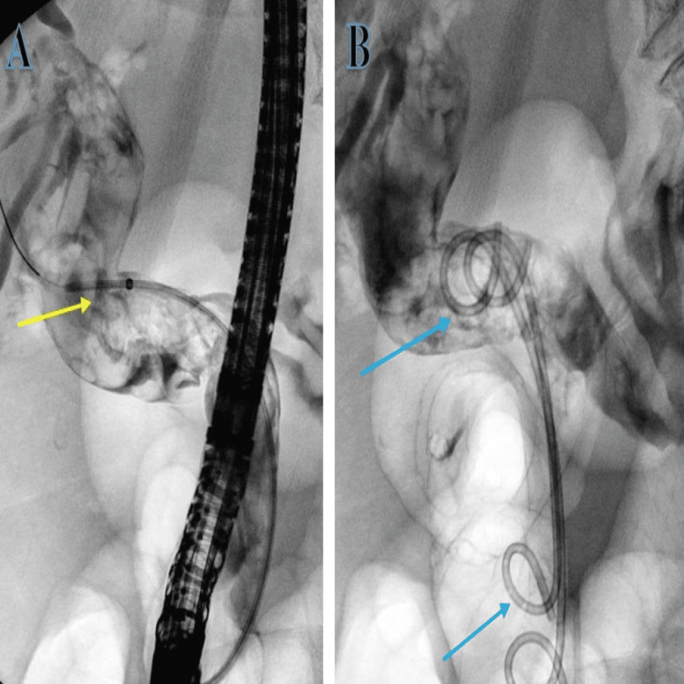 Deployment of pigtail stent with ERCP. (A) Guidewire inserted (yellow arrow). (B) Pigtail successfully deployed (blue arrows).ERCP: endoscopic retrograde cholangiopancreatography