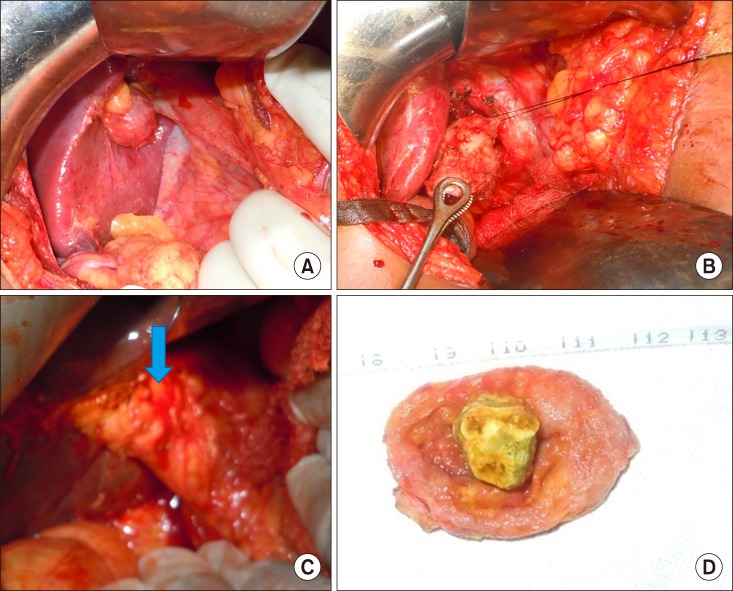 Operative picture to show (A) type I anatomy with gall bladder pouch, (B) Calot's triangle could be dissected and completion cholecystectomy was performed, (C) type II anatomy, small gall bladder with obliterated Calot's triangle (arrow), (D) small sized Gall bladder with a single large stone occupying the lumen.