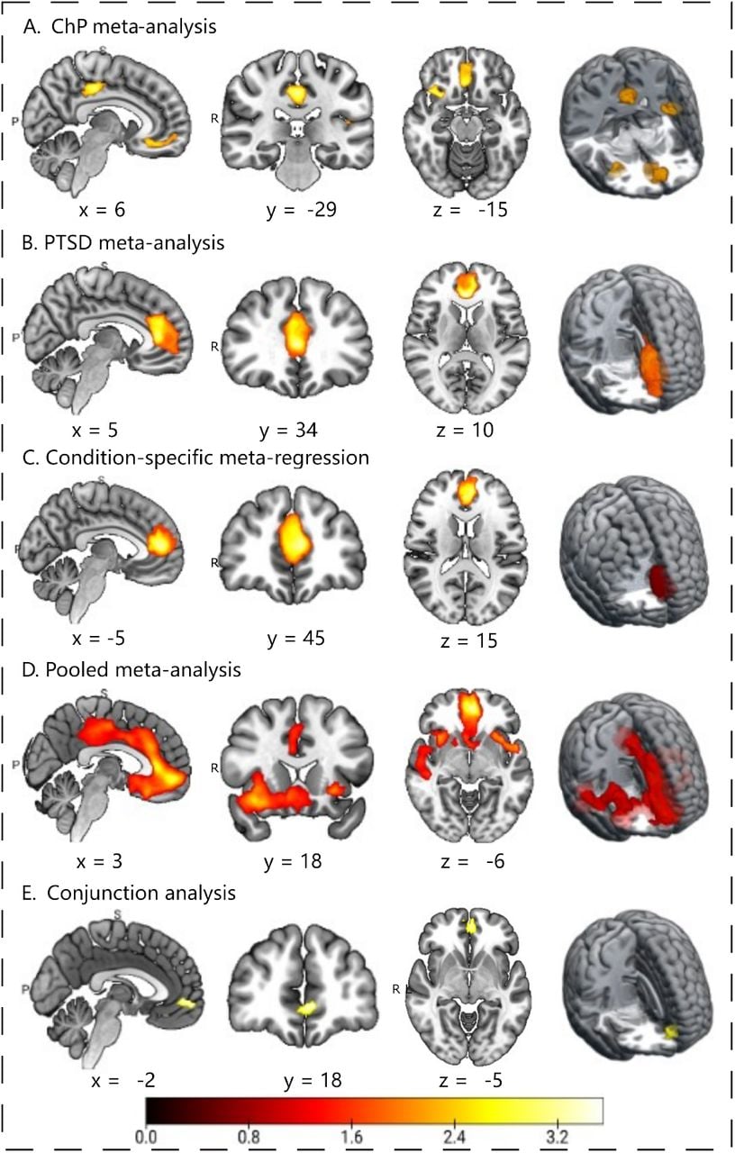 Results of SDM-based meta-analyses and conjunction analyses conducted on voxel-based morphometry (VBM) studies investigating differences between controls and patients with ChP or PTSD. For all the presented meta-analyses results, voxel-wise SDM-Z maps were thresholded at p < 0.05 TFCE-corrected for multiple comparisons, with a minimum cluster size of k > 10 voxels. A. Maps showing significant gray matter volume differences derived from the ChP dataset (60 VBM studies), reflecting brain regions where controls exhibit greater gray matter volume than ChP patients (controls > patients). B. Maps showing significant gray matter volume differences derived from the PTSD dataset (20 VBM studies), reflecting brain regions where healthy controls exhibit greater gray matter volume than PTSD patients (controls > patients). C. Maps showing significant gray matter volume differences derived from a condition-specific meta-regression comparing ChP and PTSD datasets, highlighting regions where ChP patients exhibit greater gray matter volume than PTSD patients (ChP > PTSD). D. Pooled meta-analysis maps including ChP and PTSD studies, showing brain regions where controls exhibit greater gray matter volume than patients (controls > patients). E. Maps showing brain regions identified by the conjunction analysis of the ChP and PTSD meta-analytic results, highlighting areas of overlapping gray matter volume reduction shared by both conditions. Coordinates are reported in Montreal Neurological Institute (MNI) space. Abbreviations: ChP, chronic pain; PTSD, post-traumatic stress disorder.