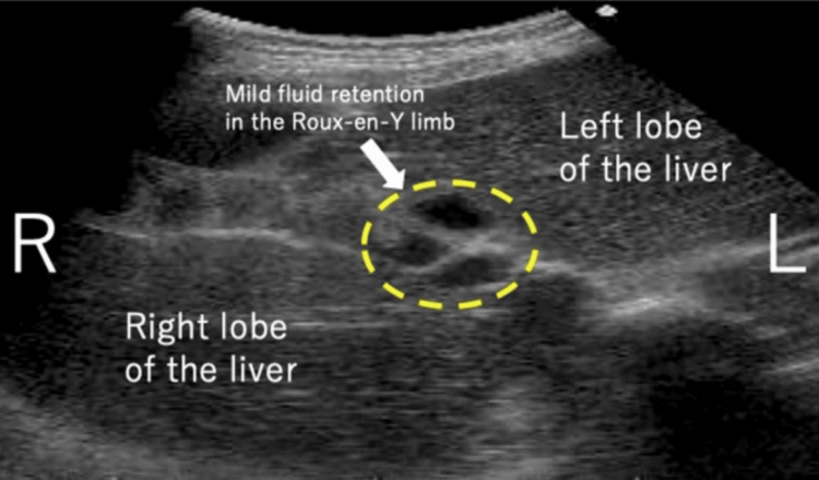 Abdominal ultrasonography.The white arrowhead represents mild fluid retention in the Roux-en-Y limb at the porta hepatis.