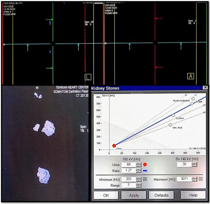 Dual-energy study curve, for evaluation of the chemical composition of cyst wall, shows blue encoding compatible with highly calcified structure. The curve was depicted on Leonardo work station, medical Siemens Somatom definition CT