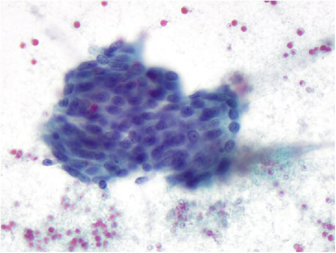 Pathology of CBD brushing showing some reactive changes and debris, negative for malignancy, but positive for acid fast bacilli.