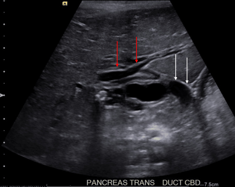 Initial abdominal ultrasoundAbdominal ultrasound (pancreas transverse view) showing several stones within the gallbladder without gallbladder wall thickening, mild to moderate intra- and extrahepatic biliary ductal dilatation with the common bile duct measuring 9 mm and an ovoid lesion measuring 1.5×0.6 cm in the distal common bile duct. Red arrows point to intrahepatic biliary ductal dilatation. White arrows point to dilated gallbladder and extrahepatic biliary ductal dilatation.