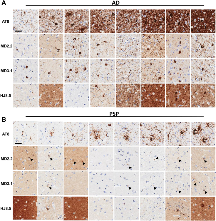 MD2.2 and MD3.1 staining of AD and PSP brains. Representative images of tissue microarray IHC staining of fixed frontal cortex of eight AD brains (A) and eight PSP brains (B) showed less total tau staining on average by MD2.2 and MD3.1 than by HJ8.5, and a distinct pattern of tau aggregates versus AT8, with perinuclear granular bodies noted particularly in PSP (arrowheads). Scale bar = 50 μm.