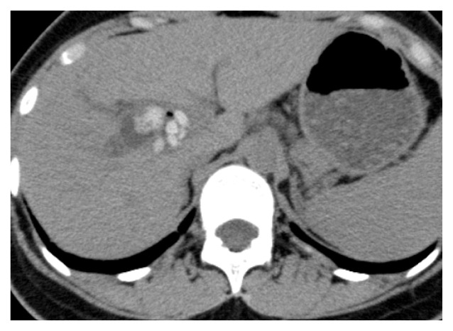 Multiple intrahepatic stones in the right hepatic duct were detected by CT scan.