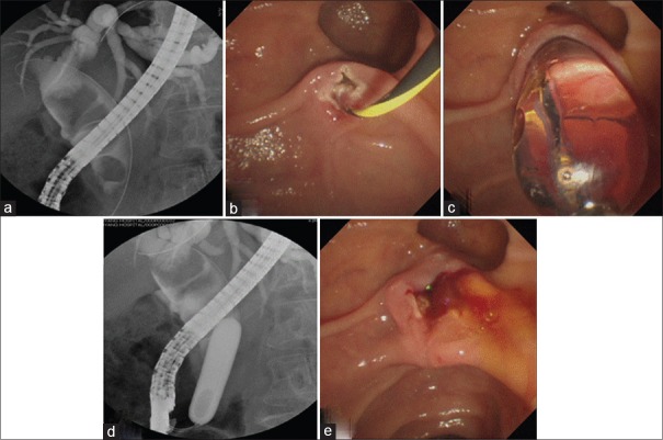 A case of large balloon dilation after minor endoscopic biliary sphincterotomy (ES) in a patient with multiple large extrahepatic bile duct stones. (a) Retrograde cholangiogram shows multiple large stones that completely fill the extrahepatic bile duct. (b-d) After minor ES, a large balloon is inflated up to 15 mm over the guidewire and through the sphincterotomized papilla. (e) The papillary orifice is dilated fully and the bile duct mucosa is readily seen