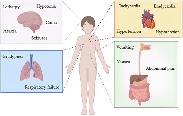 Clinical manifestations in case of acute cannabinoid intoxication in paediatric patients.