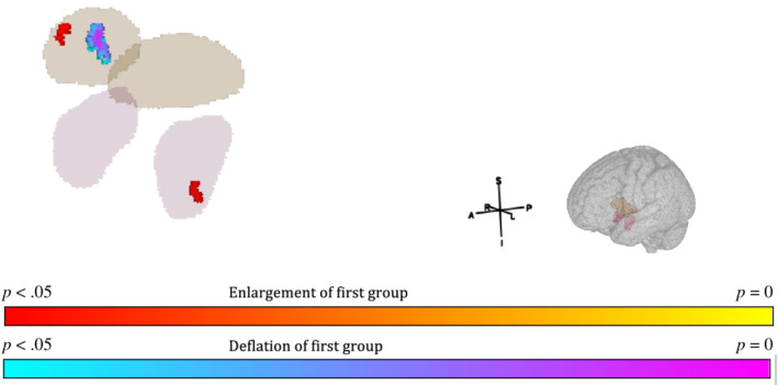 Bilateral Pallidum (brown) and Amygdala (purple) masks overlayed with significant clusters for all patients versus all controls. A, anterior; I, inferior; L, left; P, posterior; R, right; S, superior. Red‐yellow cluster indicates significant increase in patient group, blue‐purple cluster indicates significant decrease in patient group (see colour bar). TFCE, FWE p < .05