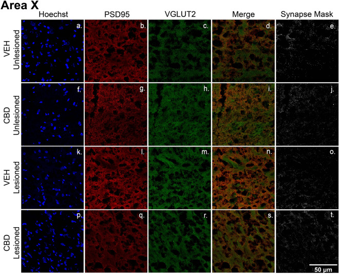 CBD treatments protect glutamatergic synaptic densities from lesion-related losses within Area X. A-T, Representative confocal images of immunofluorescence illustrating synaptic density in four groups: VEH Unleisoned (a–e), CBD Unlesioned (f–j), VEH Lesioned (k–o), and CBD Lesioned (p–t). Stain is divided into columns with Hoechst, PSD95 (postsynaptic marker), and VGLUT2 (presynaptic marker) respectfully. Column 4 is a merge of the two stains and column 5 shows a mask of the colocalized puncta of PSD95 and VGLUT2. The synapse masks show that relative to VEH controls CBD groups have significantly higher glutamatergic synapse densities 24 h post-lesions.