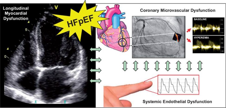 PROMIS-HFpEF study algorithm. In patients diagnosed with heart failure with preserved left ventricular ejection fraction (HFpEF) and nonsignificant coronary artery disease, coronary microvascular dysfunction was assessed based on quantification of coronary flow reserve with adenosine stress transthoracic Doppler echocardiography. In addition, conventional and speckle-tracking echocardiography was used to evaluate left and right ventricular systolic function. Peripheral arterial tonometry was used to measure systemic endothelial dysfunction.Reproduced with permission from Shah et al1