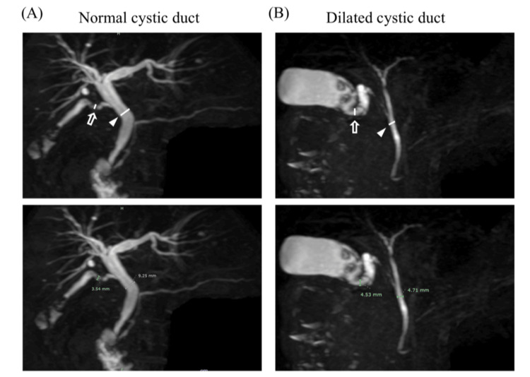 Magnetic resonance cholangiopancreatography (MRCP) images.(A) The diameters of the cystic duct were represented in both two- and three-dimensional construction images via MRCP. (B) Intraoperative images from laparoscopic cholecystectomy of patients with the MRCP image above.