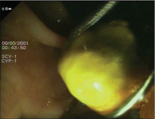 Sphincterotomy and stone extraction being done