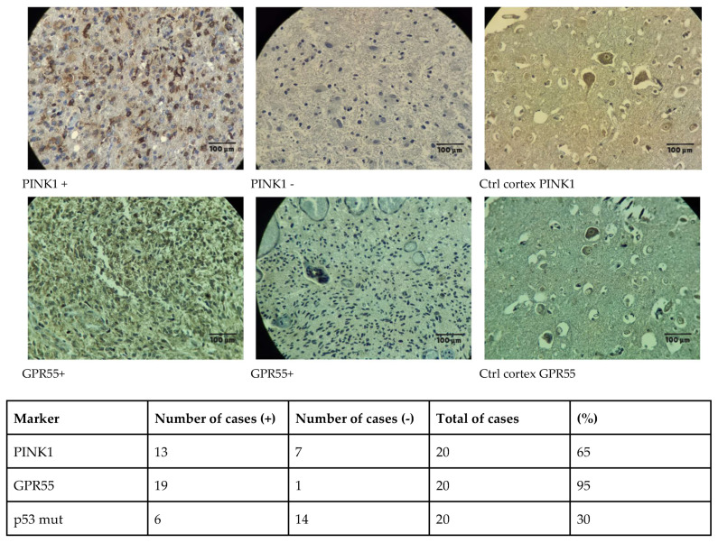 Immunohistochemical analysis of PINK1 and GPR55 expression in glioblastoma patient samples.